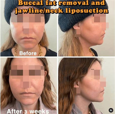 buccal fat pad removal stockholm|Boka Operation: Buccal fat pad removal .